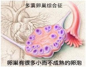 多囊卵巢试管婴儿